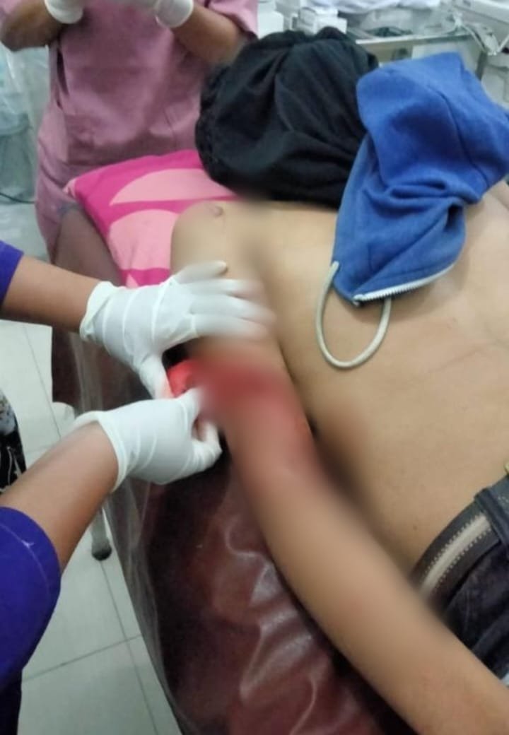 Diduga Dibacok Begal, Lengan Anak Marelan Nyaris Putus