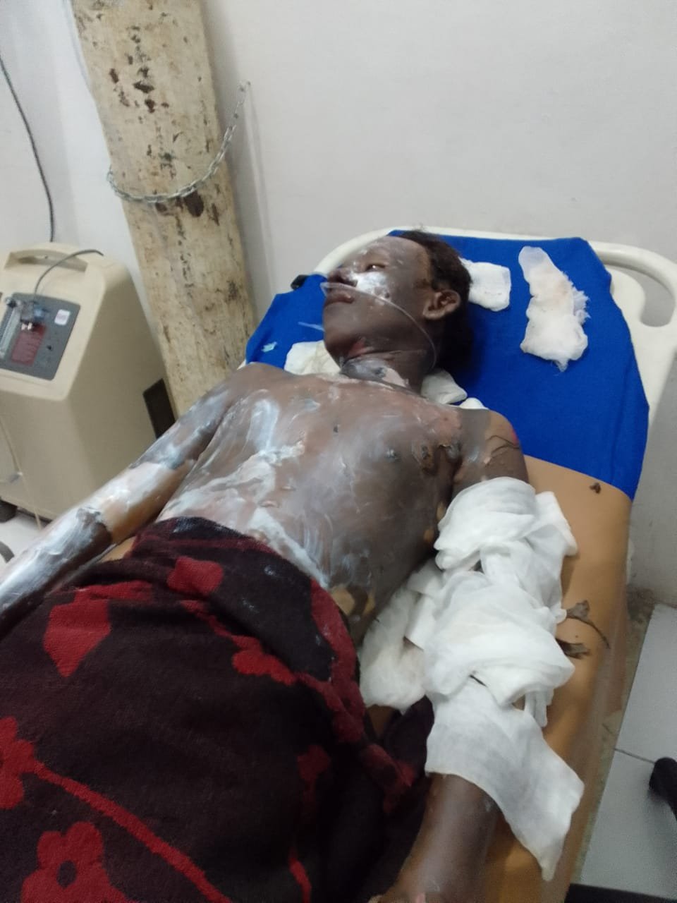 Deni Dibakarì Hidup –  Hidup  Akhirnya Tewas, Polisi Buru Dua Tersangka