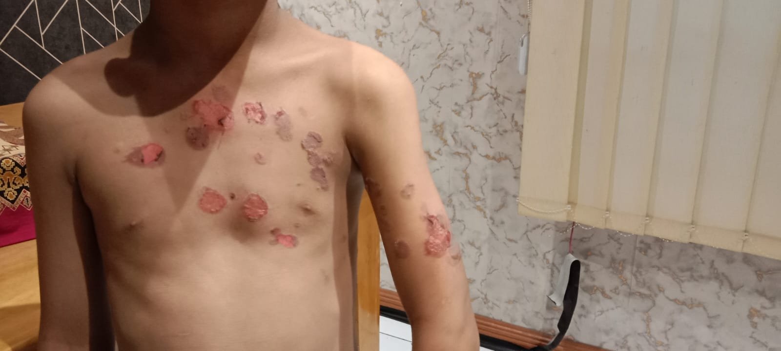 Anak 10 Tahun Disiram Air Panas, Karyawan Warkop Sabena II Multatuli Dipolisikan